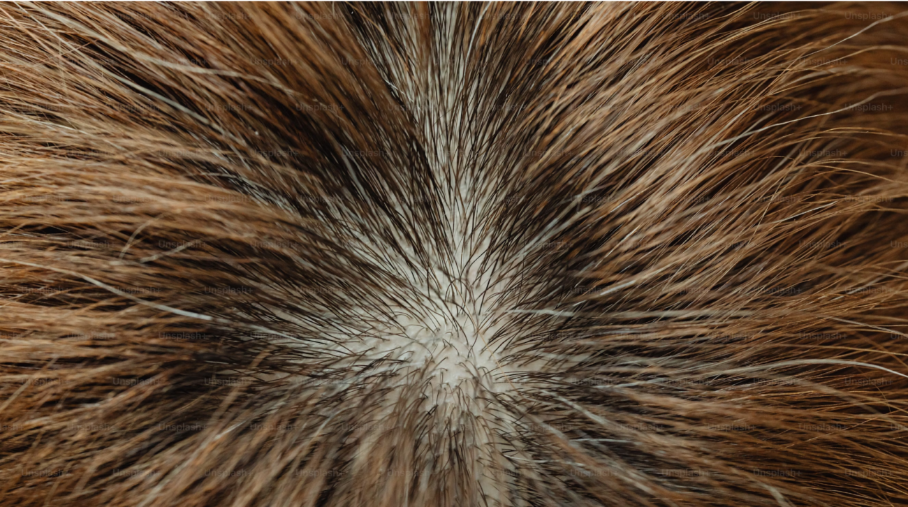 dandruff scalp