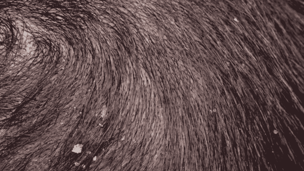 dandruff scalp and hard water