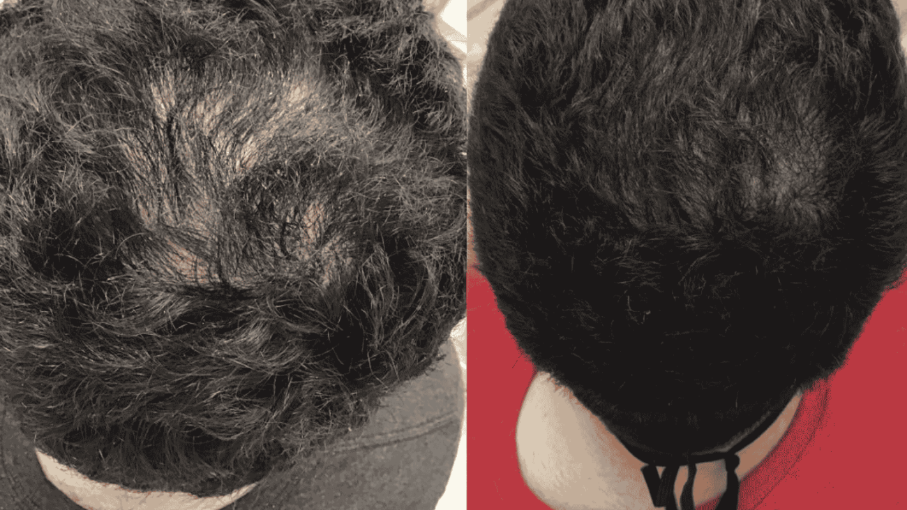 Androgenetic alopecia, Male pattern baldness, stages of hair growth cycle